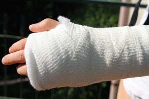 arm in a cast from a fracture
