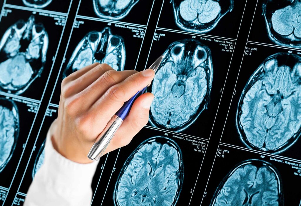 Médico analizando resonancias magnéticas cerebrales para documentar lesiones cerebrales en un caso legal en NY