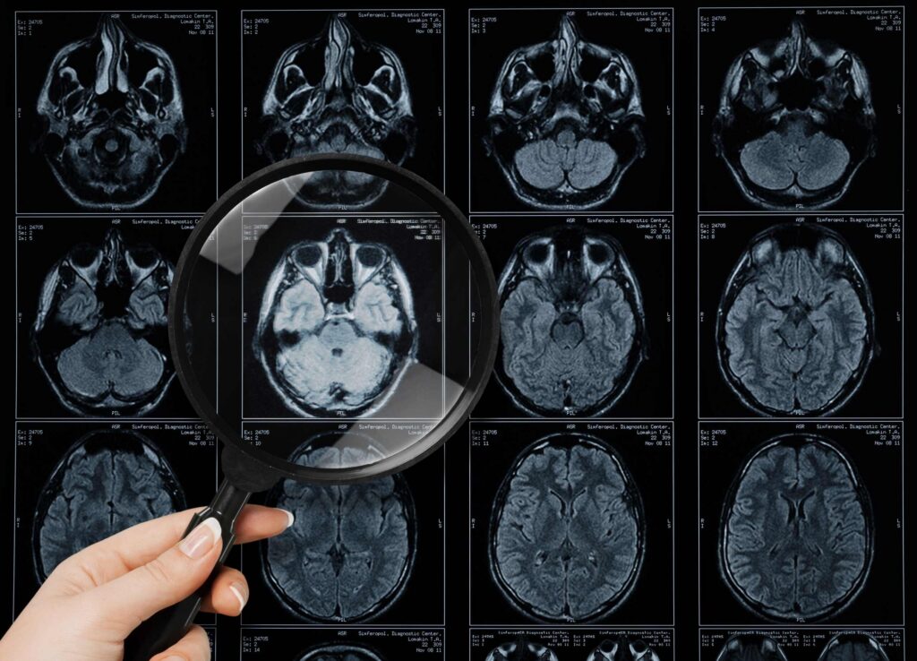 Resonancia magnética cerebral utilizada para detectar lesiones cerebrales traumáticas tras un accidente en Nueva York