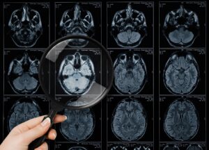 Resonancia magnética cerebral utilizada para detectar lesiones cerebrales traumáticas tras un accidente en Nueva York