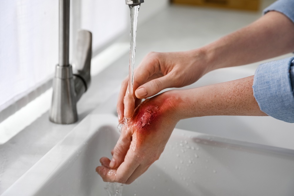 Burn injury on a hand being rinsed with water immediately after an accident