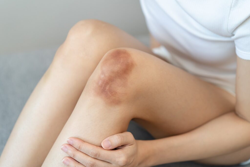 A severe knee injury demonstrates the physical impact in Constructive Notice in NYC Slip and Fall Claims.