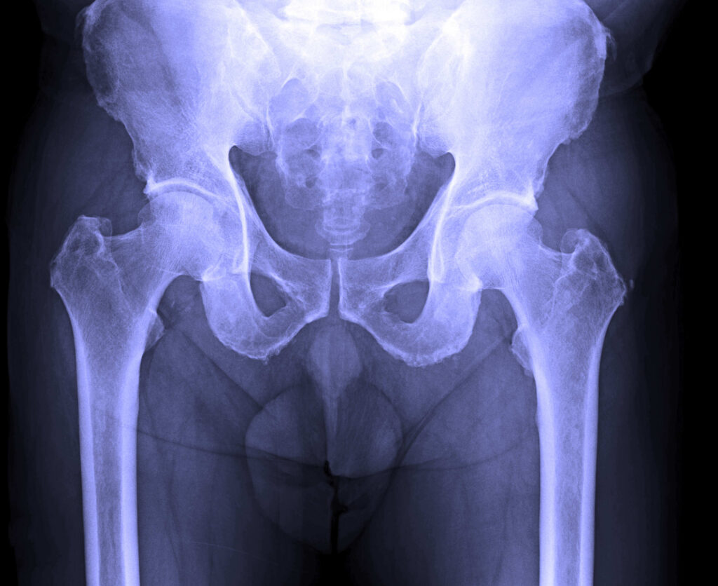 Medical X ray showing a pelvis and hip structure illustrating NY construction accident settlements realistic ranges by injury type.